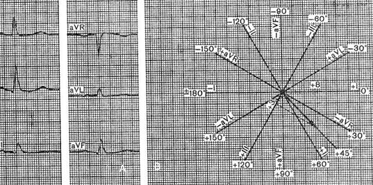 определения положения электрической оси сердца (qrs): а – экг в отведениях от конечностей, б – ось сердца в шестиосевой системе координат