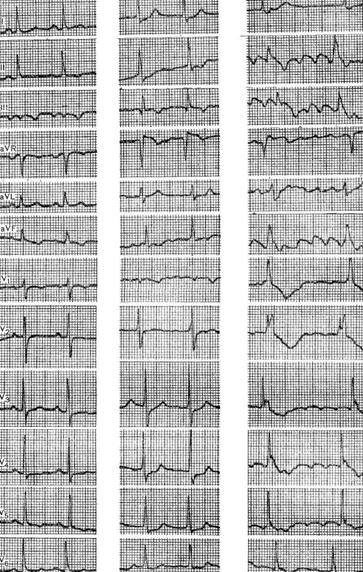электрокардиографическая динамика при остром легочном сердце