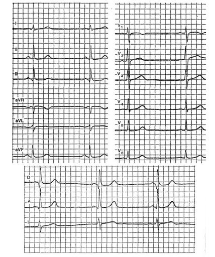 нормальная экг, вертикальное положение электрической оси сердца