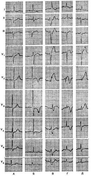 динамика рецидивирующего переднесептального инфаркта миокарда
