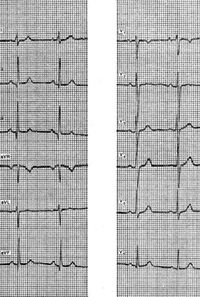 нормальная экг (скорость 25 мм/с): вертикальное положение сердца с поворотом вокруг продольной оси вправо