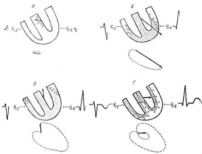 векторы возбуждения желудочков, формирование желудочкового комплекса экг и векторной петли: а - начальный (септальный) вектор (0,01–0,02 с), б – средний (главный) вектор (0,04– 0,06 с), в – конечный (базальный) вектор (0,07–0,08 с), г–вектор реполяризации