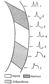 схема изменений комплекса qrs электрокардиограммы при инфарктах миокарда: 1 – норма, 2–3 – субэндокардиальный некроз, 4 – трансмуральный некроз, 5 – участок нормального миокарда среди некротического поля, 6–7 – субэпикардиальный некроз, 8 – интрамуральный некроз