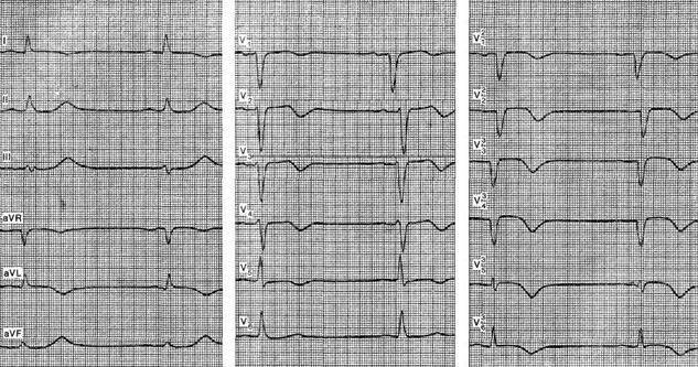 острый трансмуральный инфаркт высоких отделов передней стенки