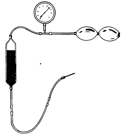 монтаж ампулы для впутриартериального нагнетания крови.