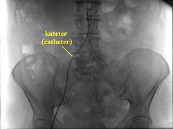 https://upload.wikimedia.org/wikipedia/commons/thumb/2/2b/catheterization_selective_angiography.jpg/250px-catheterization_selective_angiography.jpg
