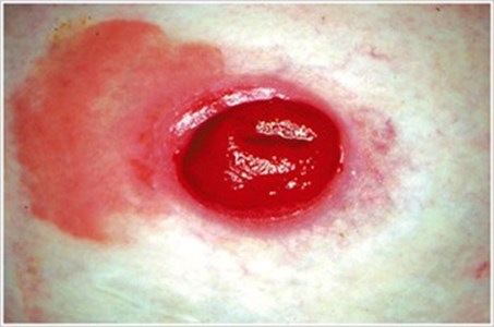 картинки по запросу перистомальный дерматит