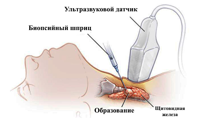 http://schitovidka03.ru/wp-content/uploads/2017/09/biopsiya-shema.jpg