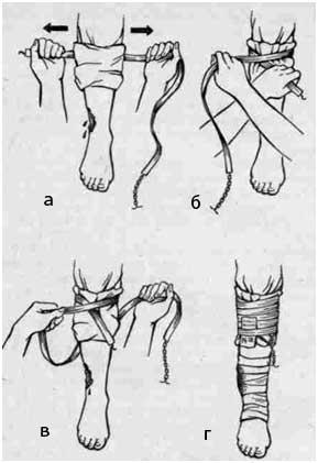 описание: наложение кровоостанавливающего жгута