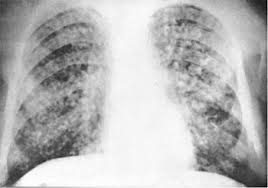 картинки по запросу диссеминированный туберкулез