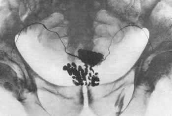 http://uroweb.ru/catalog/med_lib/rg_ur/img/314.jpg