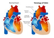 tetralogy of fallot.svg