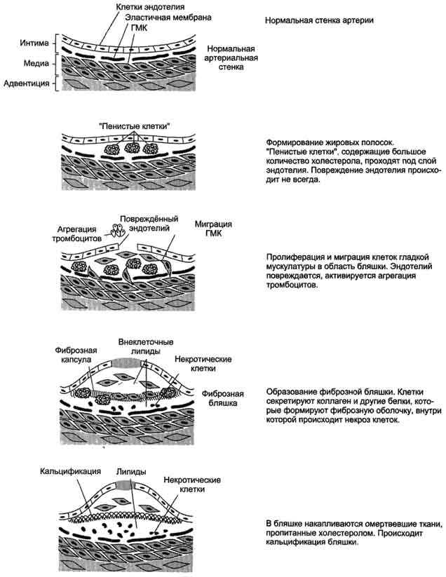 рис. 8-76. развитие атеросклеротической бляшки в клетках эндотелия кровеносных сосудов.