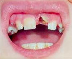 травмы зубов