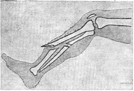 Какой вид травмы показан на рисунке. Схема закрытого (слева) и открытого (справа) перелома костей голени.. Открытый перелом кости.