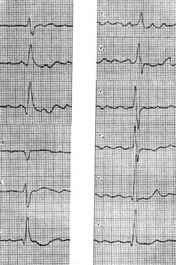 Поворот сердца правым желудочком вперед что это. Гипертрофия обоих желудочков на ЭКГ. Поворот сердца правым желудочком ЭКГ. ЭКГ при поворотах сердца вокруг продольной оси. Поворот сердца верхушкой кзади на ЭКГ.