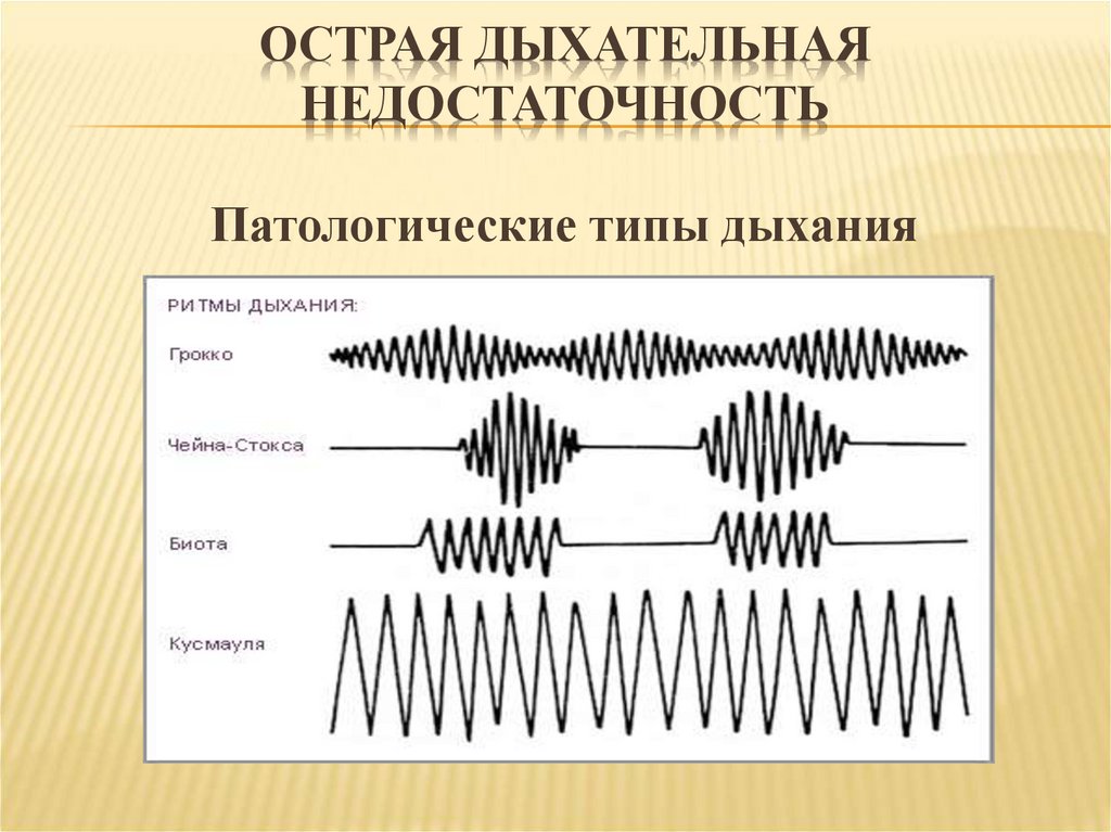 Патологическое дыхание рисунок