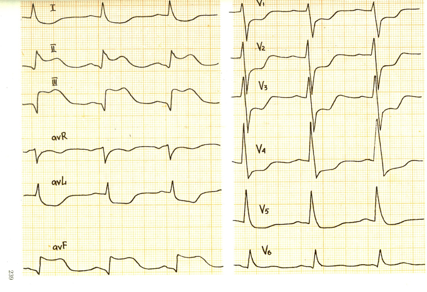 Ишемия боковой стенки. Инфаркт миокарда v1-v3 ЭКГ. ЭКГ при ишемии и инфаркта миокарда. Инфаркт в 3 отведении на ЭКГ. Инфаркт миокарда с зубцом q на ЭКГ.