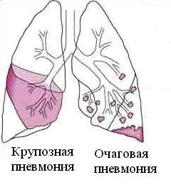 Крупозная пневмония рисунок