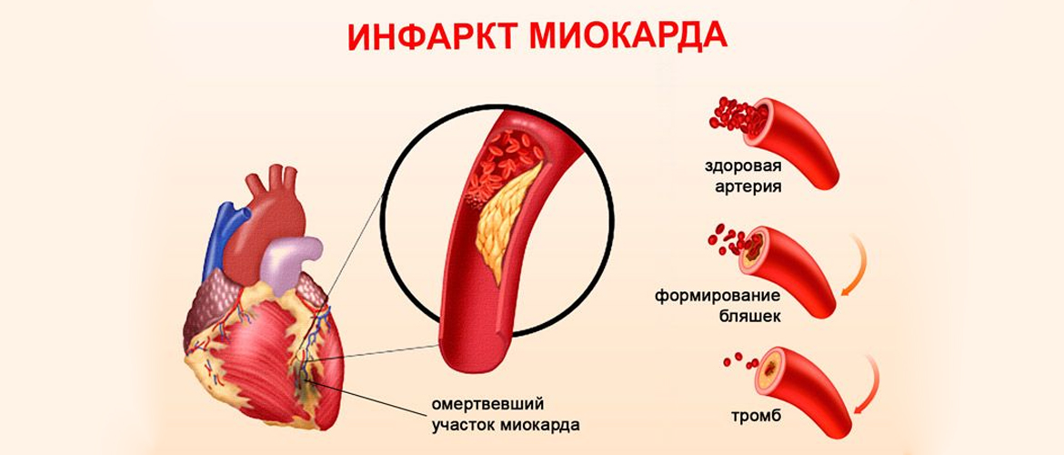 Миокард инфарктісі презентация