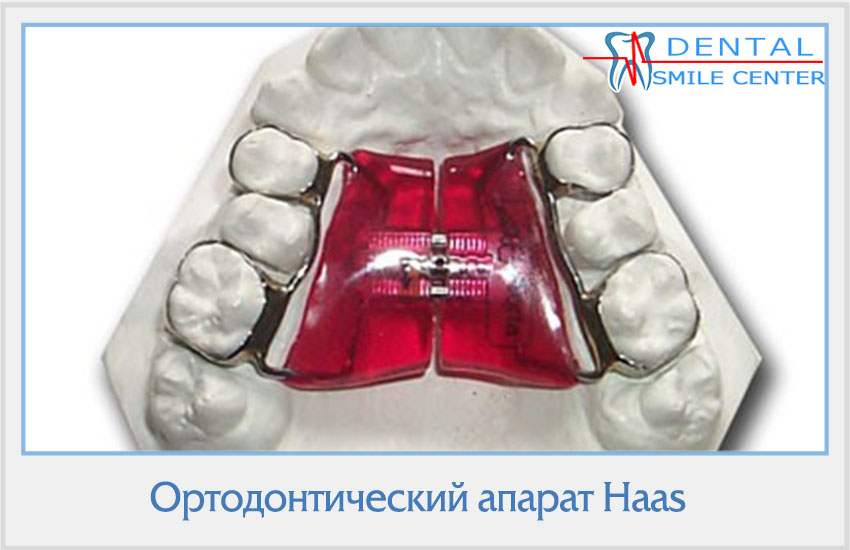 Аппарат для расширения челюсти для детей. Аппарат Марко Росса ортодонтия. Аппарат Haas ортодонтия расширение.