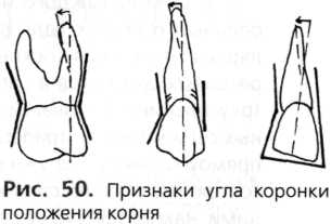 Признаки коронки зуба. Признак кривизны корня зуба. Кривизна коронки зуба. Признак кривизны коронки. Признак кривизны эмали коронки.