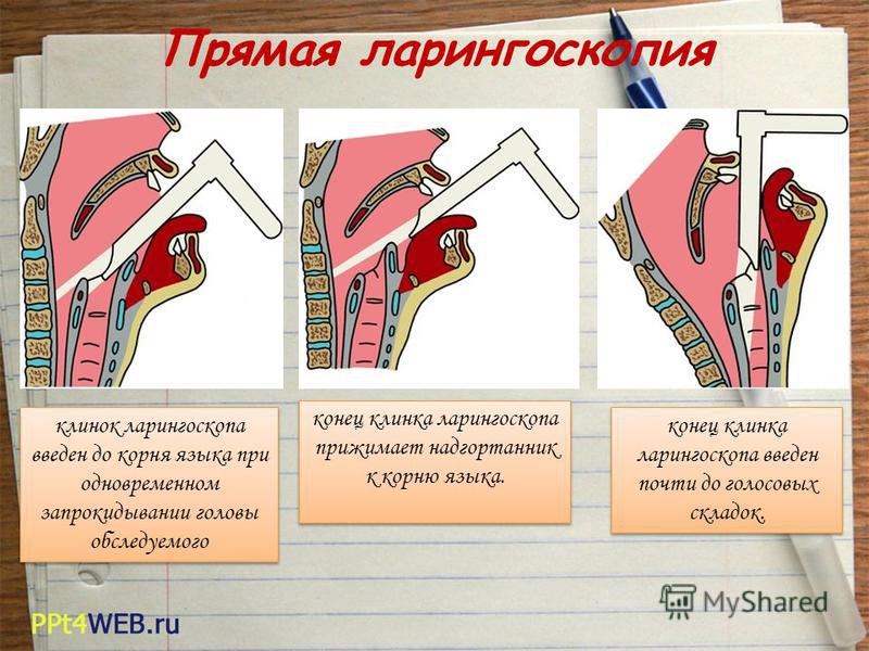 Ларингоскопия. Ларингоскопия надгортанника. Методика проведения непрямой ларингоскопии. Строение гортани ларингоскопия. Ларингоскоп, техника прямой ларингоскопии.