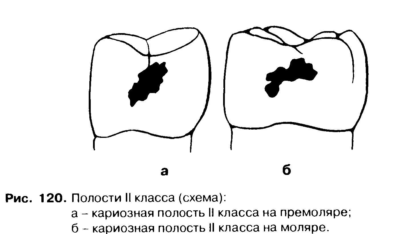 Виды полостей. Второй класс кариозной полости по Блэку. Препарирование полостей 2 класса по Блэку. Классификация кариеса по Блэку и препарирование. Классы кариозных полостей по Блэку.