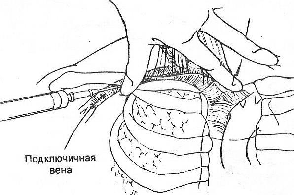 Левая подключичная вена. Подключичная Вена анатомия. Анатомия подключичной вены. Методика пункции подключичной вены. Катетер для подключичной вены.