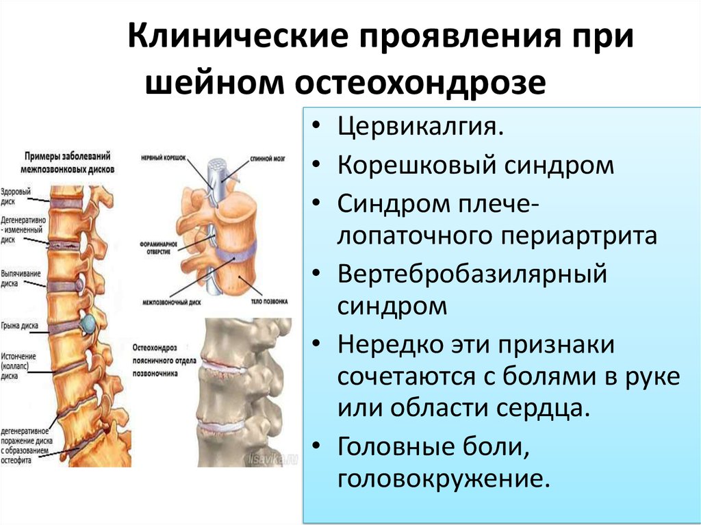 Цервикалгия шейного отдела позвоночника карта вызова скорой медицинской помощи