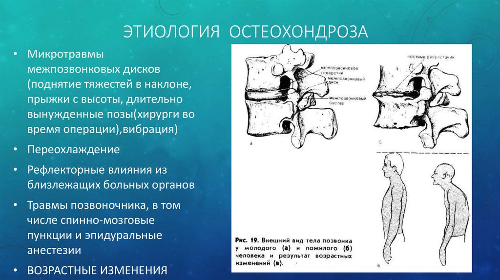 Патогенез остеохондроза позвоночника. Этиология и патогенез остеохондроза поясничного отдела позвоночника. Остеохондроз этиология и патогенез. Механизм развития остеохондроза. Позвонковый остеохондроз этиология.