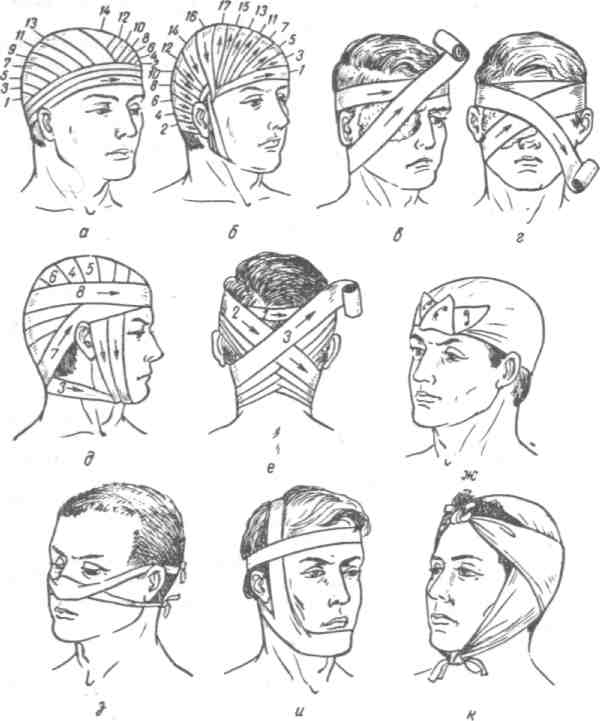 Основные способы при ранении головы. Десмургия повязка уздечка. Десмургия повязка чепец. Десмургия наложение повязок на голову. Десмургия чепец на голову.