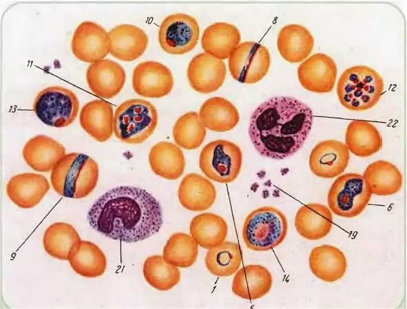 Малярийный плазмодий клетка. Малярийный плазмодий в эритроцитах человека. Малярийный плазмодий в эритроцитах крови. Малярийный плазмодий в крови человека. Малярийный плазмодий мазок крови.