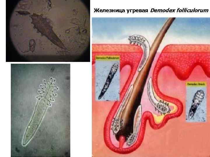 Клещ демодекс на глазах схема