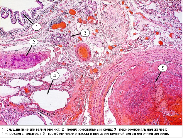 Тромб в печени. Тромб патологическая анатомия. Смешанный тромб в Вене микропрепарат. Смешанный тромб артерии микропрепарат.