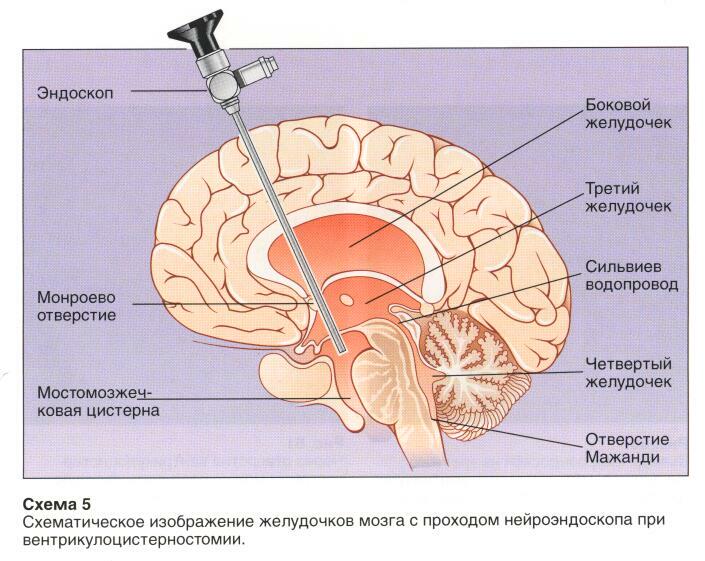 Операция гидроцефалия мозга. Гидроцефалия эндоскопия головного мозга. Эндоскопический вентрикулостомия дна 3 желудочка головного мозга. Эндоскопическая вентрикулоцистерностомия дна третьего желудочка. Эндоскопическая вентрикулоцистерностомия.