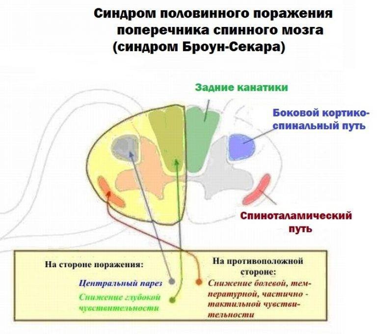 Синдром броун секара это. Синдром половинного поражения спинного мозга Броун Секара. Поражение половины поперечника спинного мозга. Симптом Броун Секара неврология. Синдром половинного поражения поперечника спинного мозга.