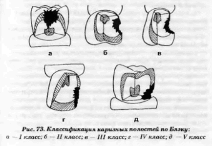 Классификация полостей