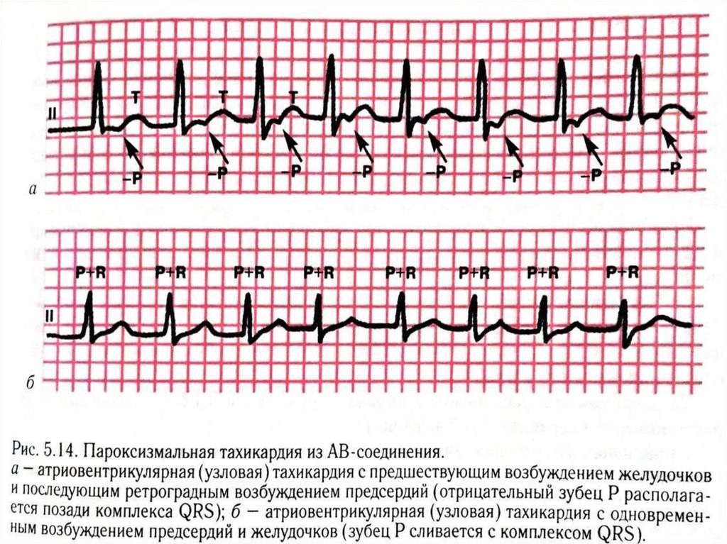 Что такое пароксизмальная тахикардия. Пароксизмальная реципрокная тахикардия. Суправентрикулярная тахикардия ЭКГ. Суправентрикулярная пароксизмальная тахикардия на ЭКГ. Узловая пароксизмальная тахикардия.