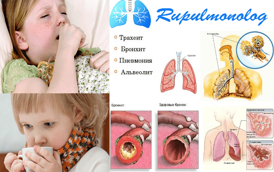 Трахеит у детей лечение