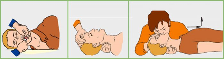 Способ рот в нос. Искусственная вентиляция легких (ИВЛ) человека алгоритм. Техника проведения искусственного дыхания изо рта в нос.