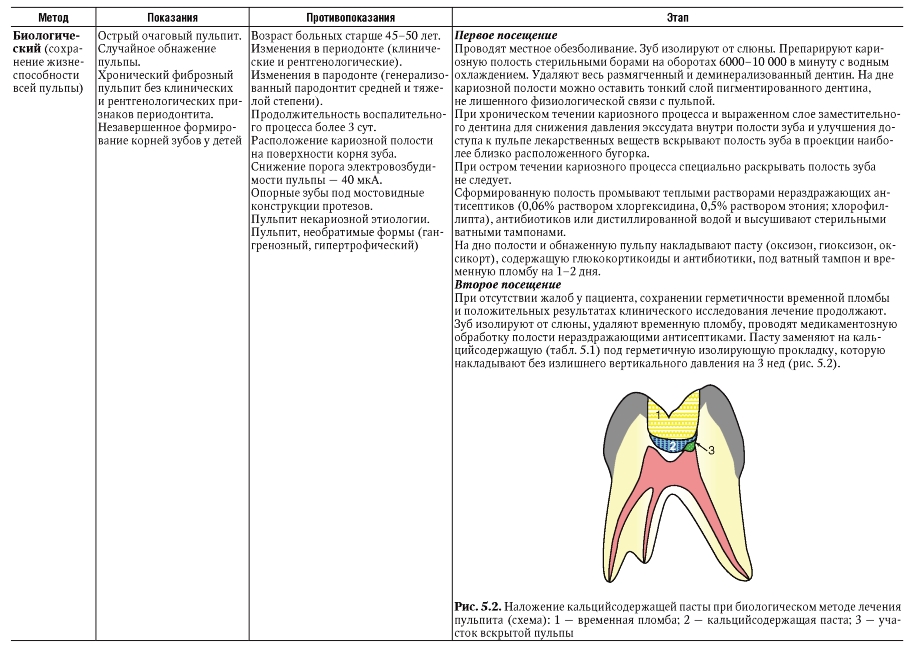 Схема лечения пульпита