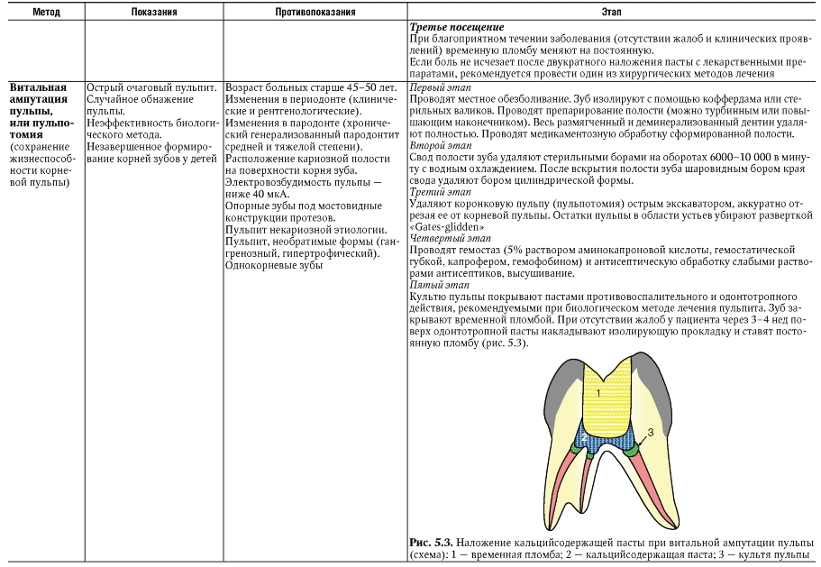 Схема лечения пульпита