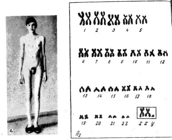 Синдром клайнфельтера картинки
