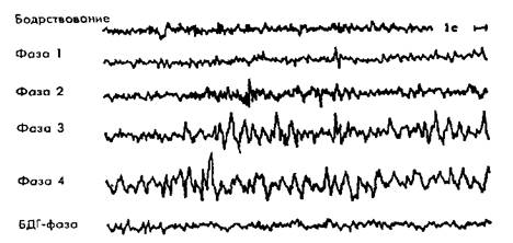 Схема стадий сна по данным ээг