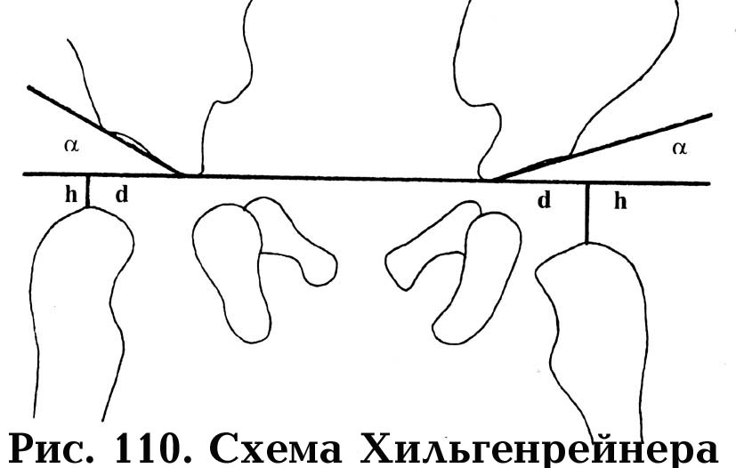 Ацетабулярный угол у детей