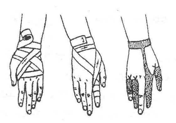 Повязка на кисть. Восьмиобразная повязка на лучезапястный сустав. Наложите восьмиобразную повязку на лучезапястный сустав.. Восьмиобразная повязка на кисть техника. Техника наложения восьмиобразной повязки на кисть.
