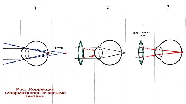 Гиперметропия 1 степени глаз. Коррекция гиперметропии очковыми линзами. Линзы для для коррекции гиперметропии. Аккомодация при миопии. Принципы коррекции гиперметропии.
