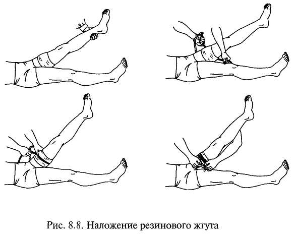 Схема наложения жгута