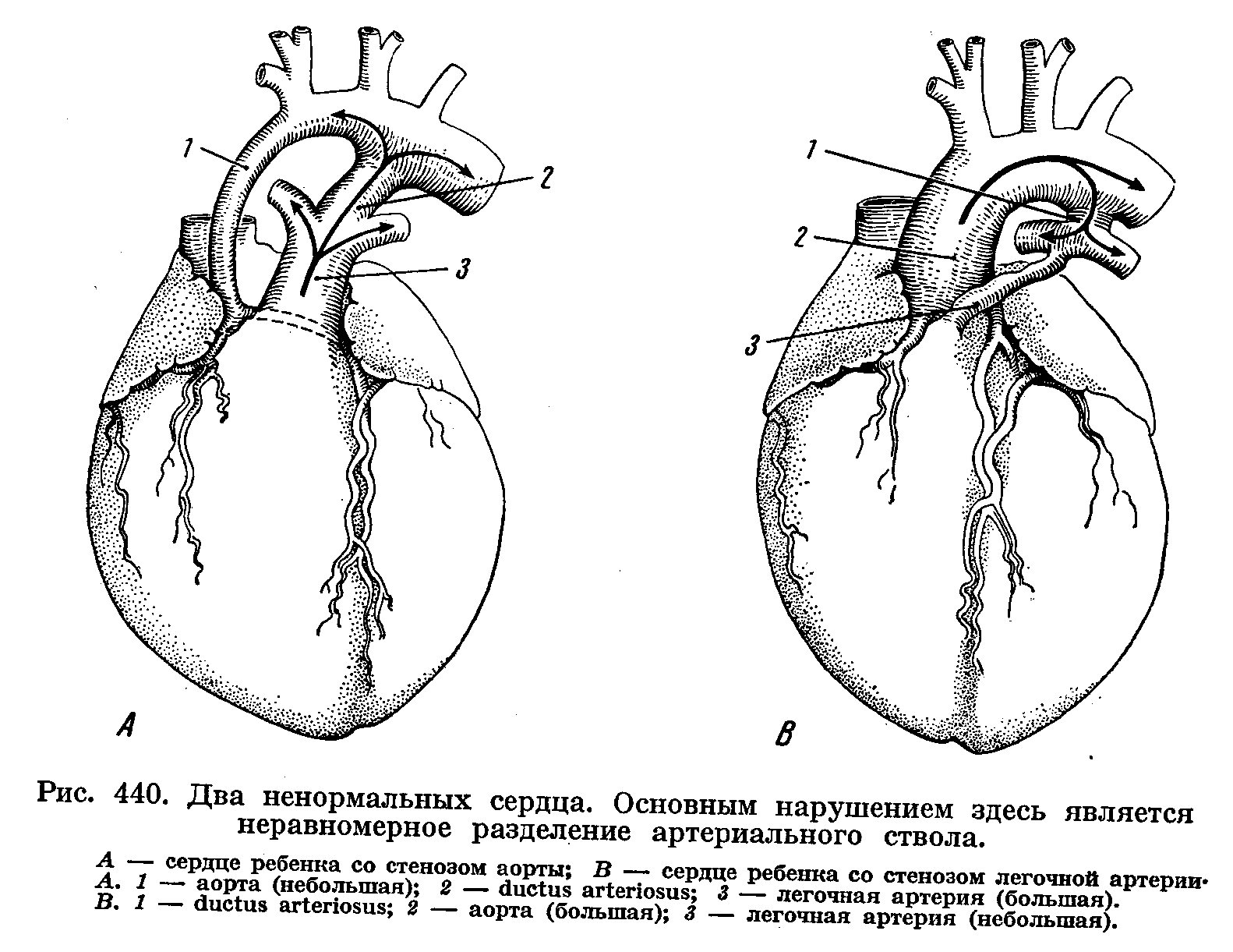 Сердечный стеноз. Сужение отверстия аорты у животных. Аномалия Эбштейна сердца врожденный порок. Пороки развития сердца и крупных сосудов. Общий артериальный ствол гемодинамика.